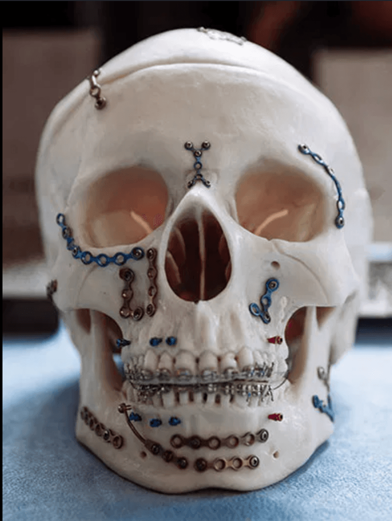 Maxillofacial Trauma